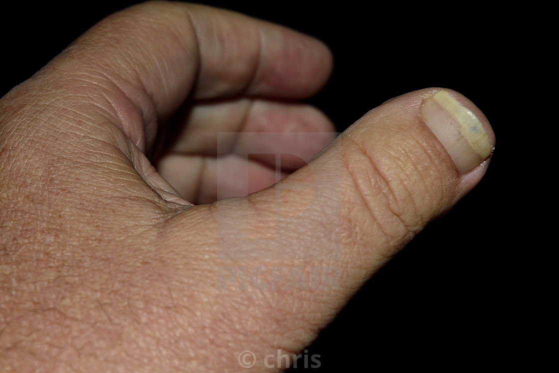Brachydactyly thumb type d or clubbed thumb - License, download or